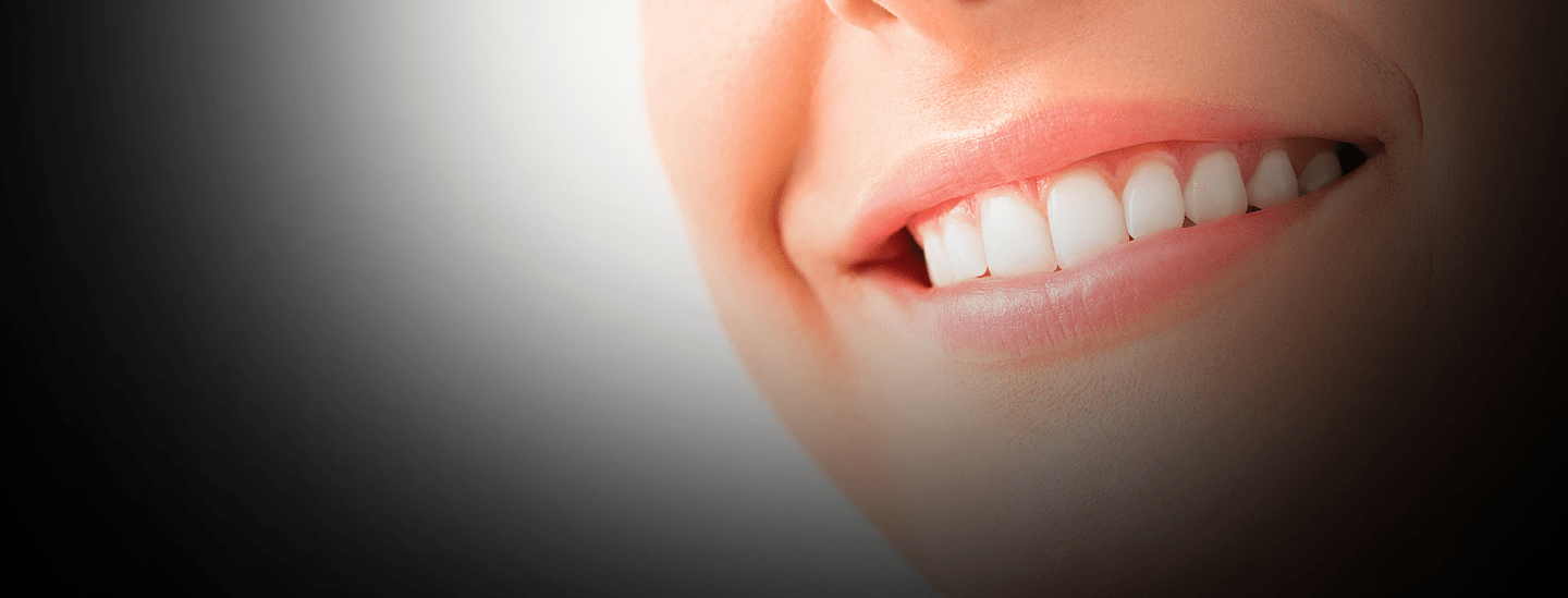 dental veneers
