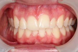 Invisalign results