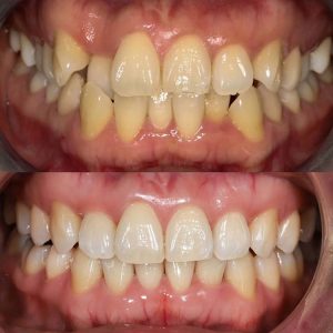 LH1 Invisalign case study Claremont dentist Perth Invisalign (5)