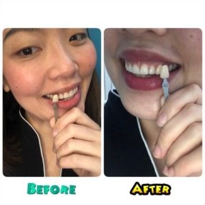 teeth whitening natural toothpaste Perth dentist cosmetic dentistry Claremont