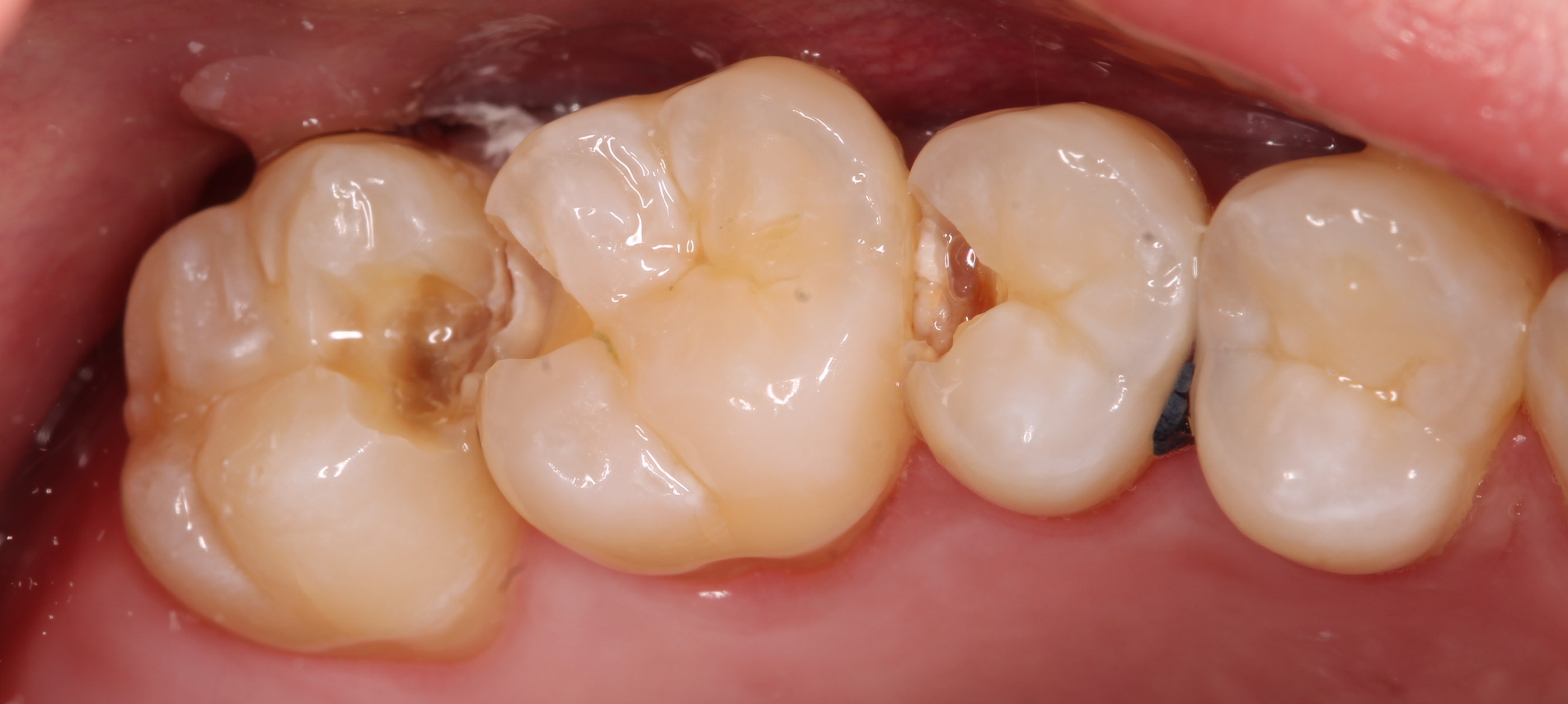 tooth decay health supplements