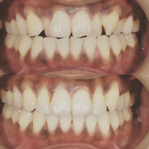 Invisalign Perth Claremont cosmetic dentistry clear aligners