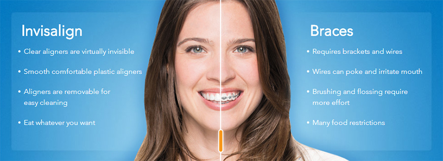 Invisalign results Perth dentist