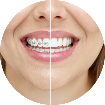 invisalign