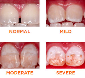 how to fix white spots on teeth dentist Perth cosmetic dentistry Claremont dental