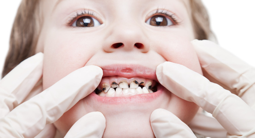 cavities in children