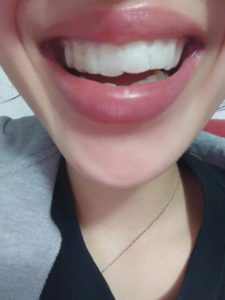 dentist Claremont tooth whitening oral b whitening strips
