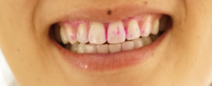 oil pulling cosmetic dentist Perth Claremont dentist tooth whitening