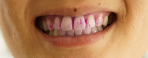 oil pulling cosmetic dentist Perth Claremont dentist tooth whitening
