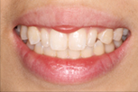 su-lin before Dentist Claremont Cosmetic Dentist Perth Claremont Dental