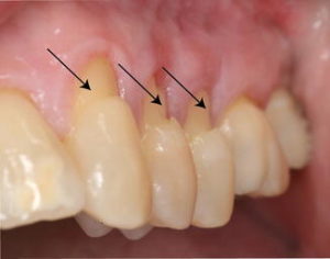 toothbrush abrasion dentist Claremont Perth cosmetic dentistry