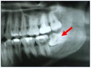 wisdom teeth surgery Perth dentist Claremont dental practice